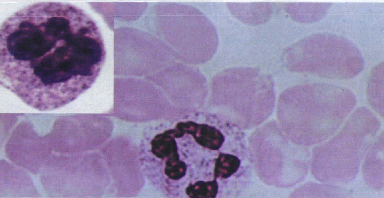 图15 中性粒细胞中毒颗粒